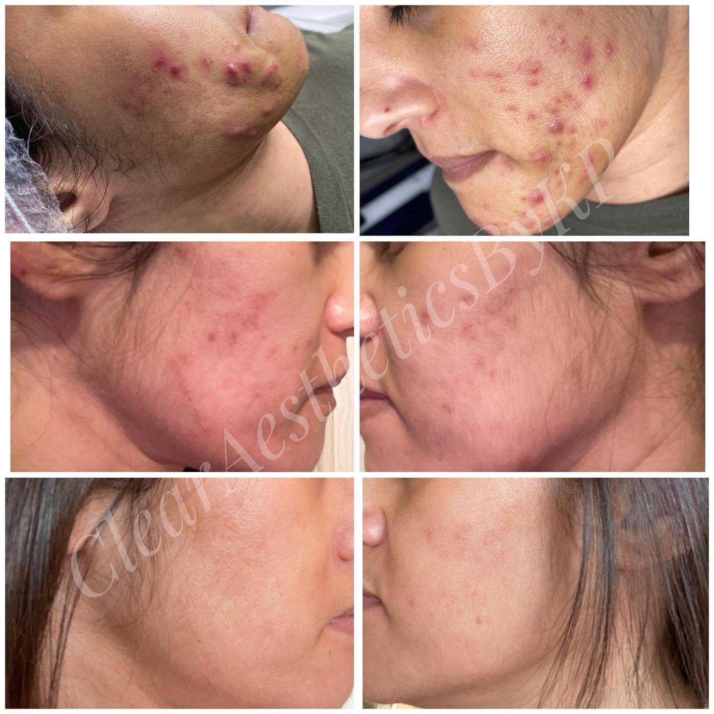 acne-2-before-and-after
